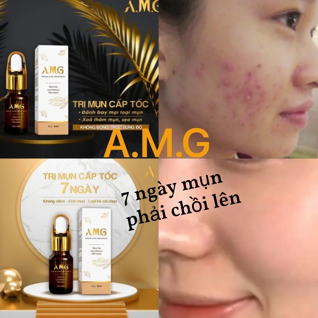 [HCM]Thảo dược Amg skin care 5ml + tặng son kem Laneige
