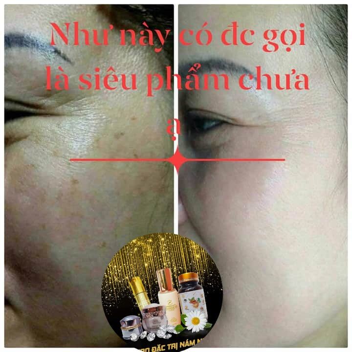 [HCM]vua nám nghệ collagen ngày