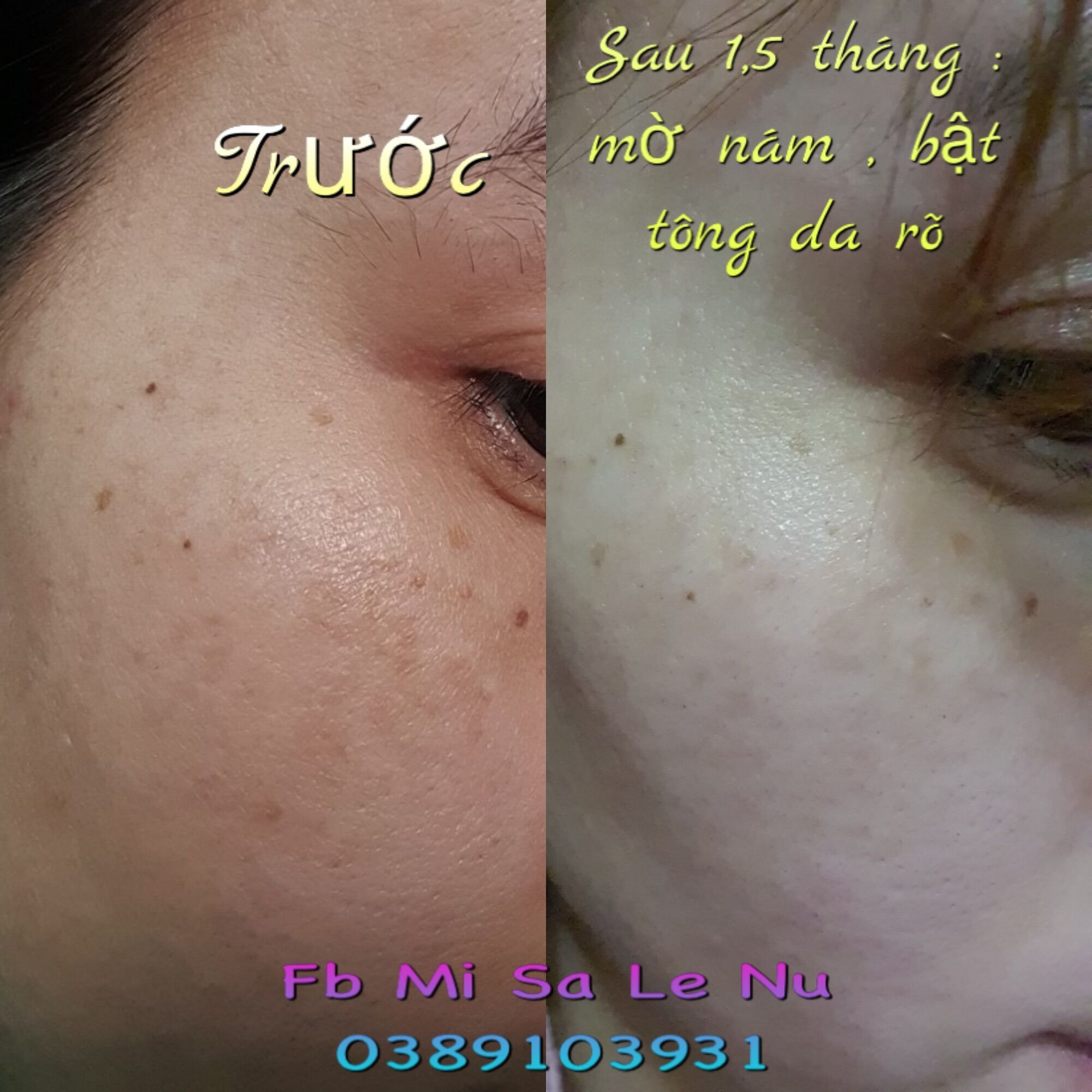 [HCM]vua nám nghệ collagen ngày