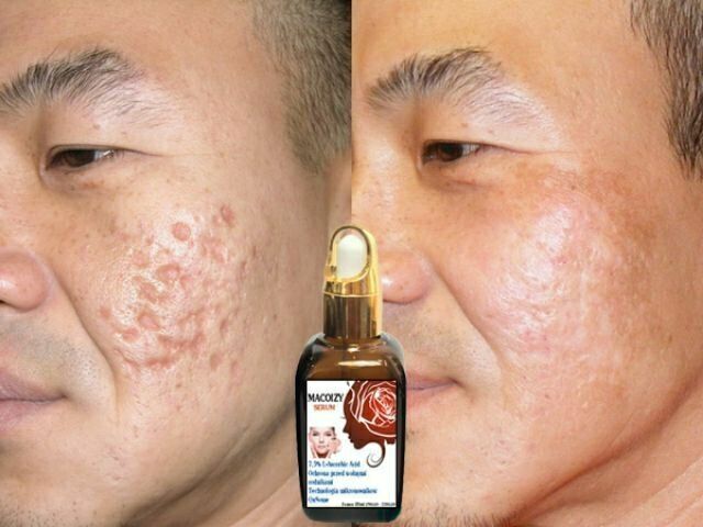 [Hcm]Serum Lành Sẹo Rỗ Macoizy