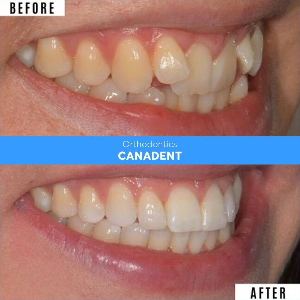 [HCM](NIỀNG RĂNG) BỘ 3 NIỀNG RĂNG SILICON CANADENT ALIGNMENT.