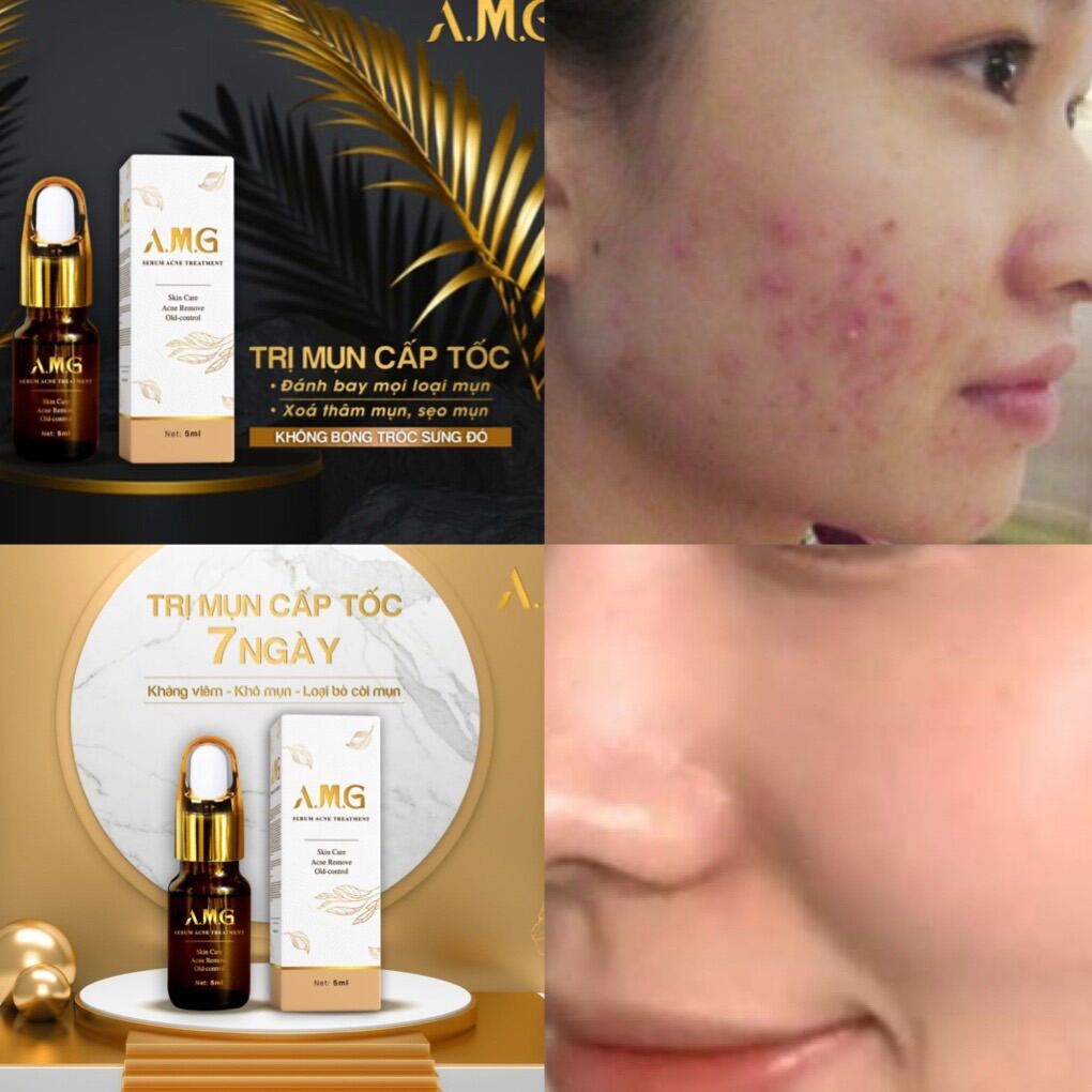 [Hcm]Serum Mụn A.m.g Ance Treatment 5Ml