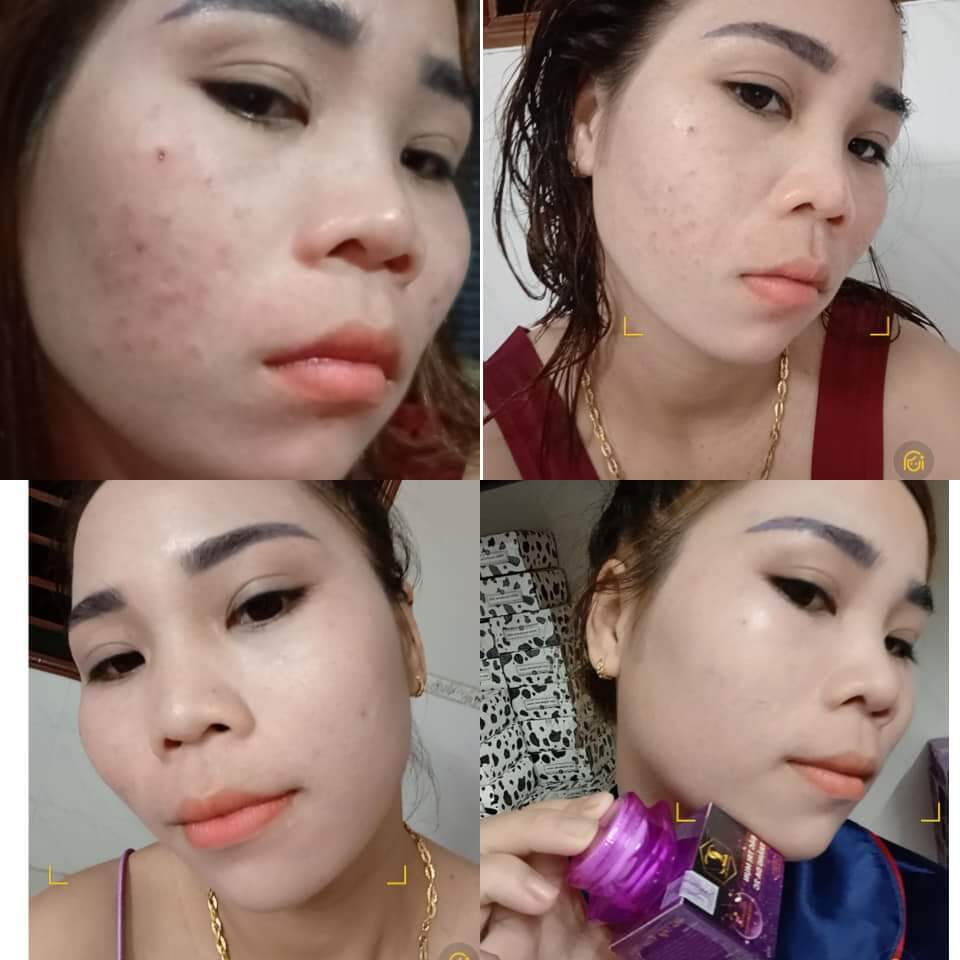 COMBO 5 HỘP KEM MỤN VÀ DƯỠNG DA 2C