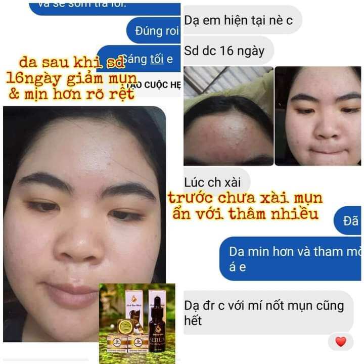 COMBO KEM TRÀ XANH MỤN SERUM BÍCH CAO WHITE