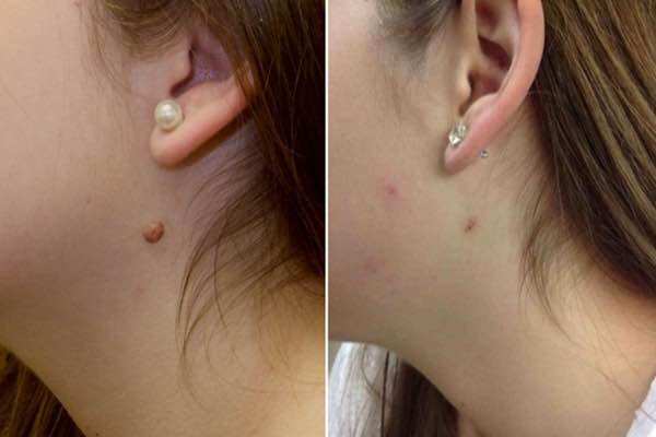 Xoá Mụn Cóc Mụn Thịt ConCon Thái Lan