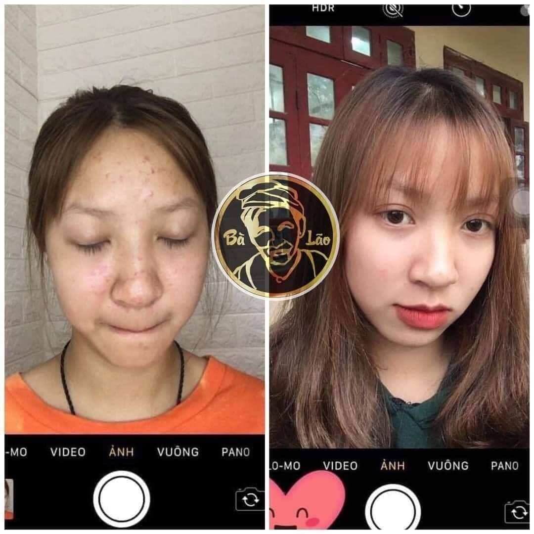 [MUA 1 TẶNG 1] COMBO TÁI TẠO HỎA TỐC RED PEEL MẪU MỚI 2% 2022