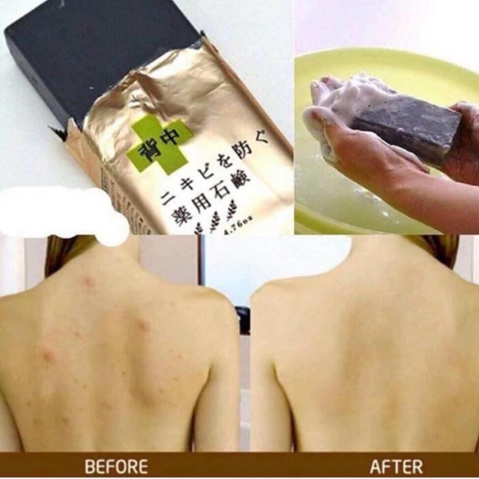 Xà phòng ngừa mụn lưng For Back Nhật Bản