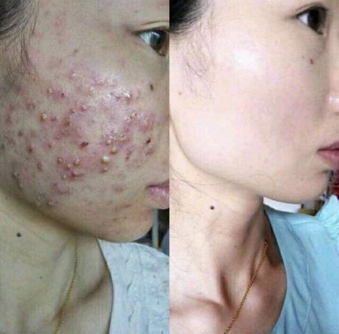 Kem xanh chuyên mụn