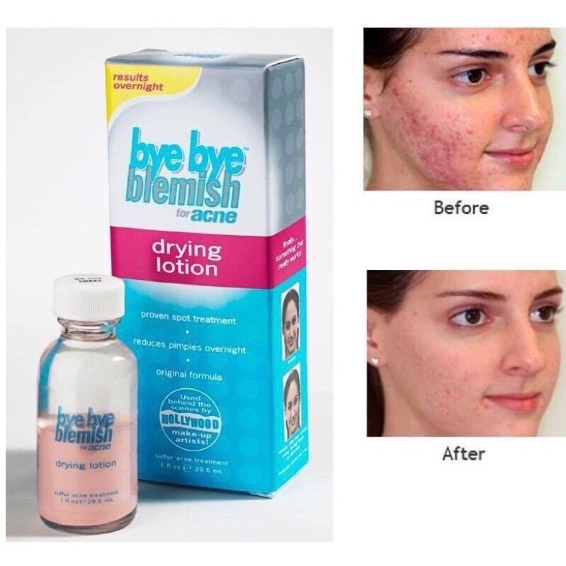 GIẢM MỤN BYE BYE BLEMISH CỦA MỸ