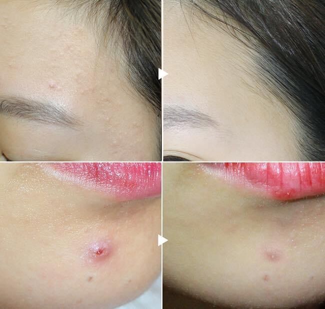 Kem Giảm Mụn Benzac AC 5%
