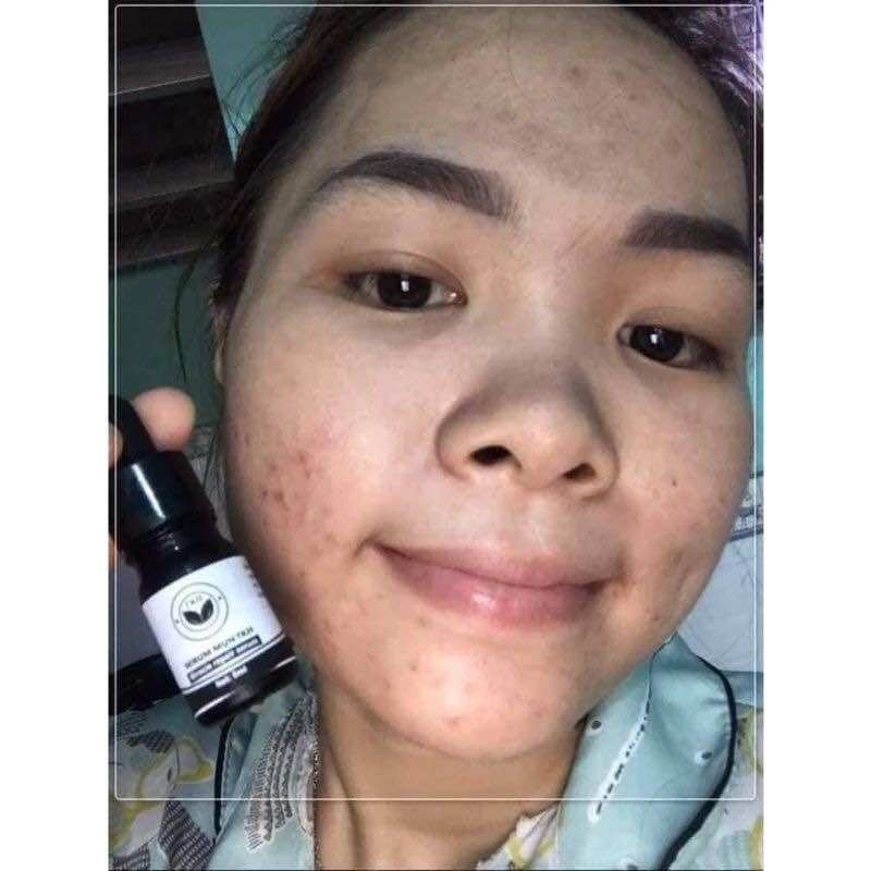 SERUM MỤN TRẦN KIM HUYỀN