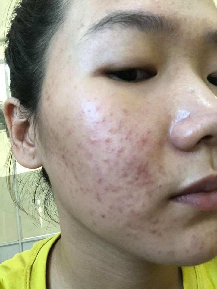 COMBO 3 MÓN SẠCH MỤN IGREEN ( mặt nạ serum và sữa rửa mặt)