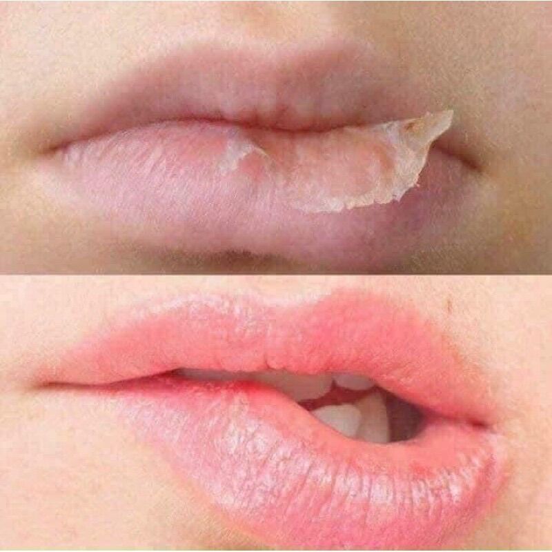 KEM NẺ VASELINE VIỆN BỎNG QUỐC GIA