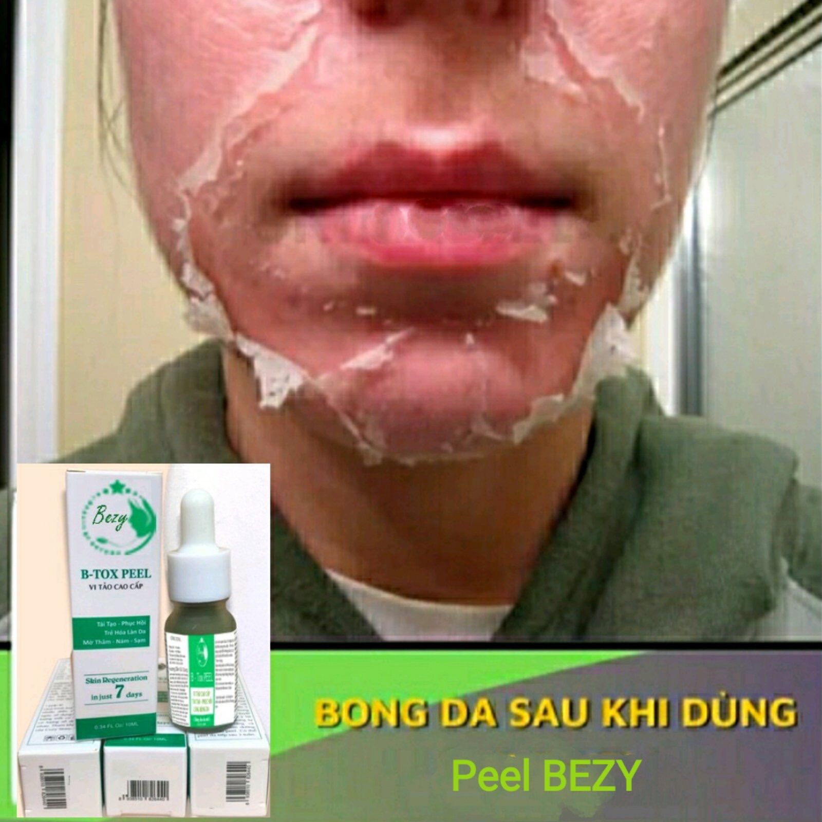 Peel vi tảo bong mạnh hút nám sạm da đẹp sau 7 ngày