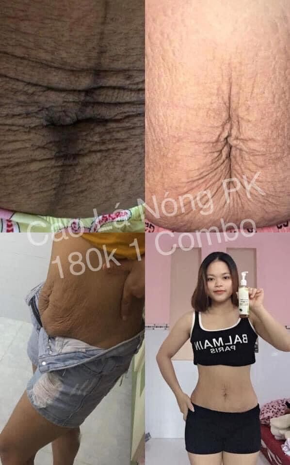 Cao lá nóng gia truyền ( giảm mỡ bắp tay- chân- đùi- bụng )