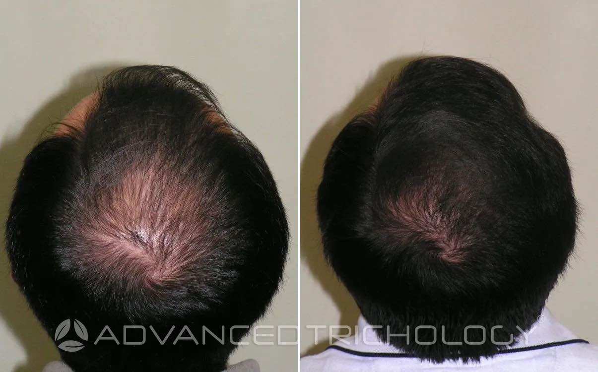 Advanced Trichology DHT Blocker, DHT MỸ Giúp Mọc Tóc Giảm Rụng 120 Viênn