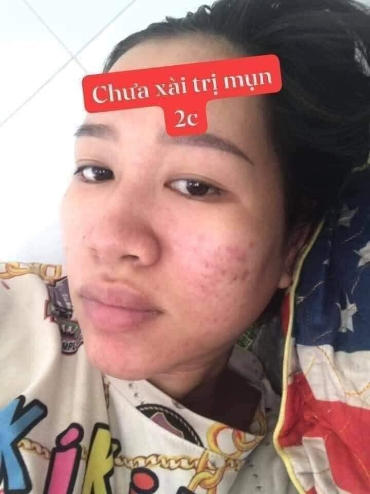 Kem mụn 2c giúp đánh bay mụn nám tàn nhang