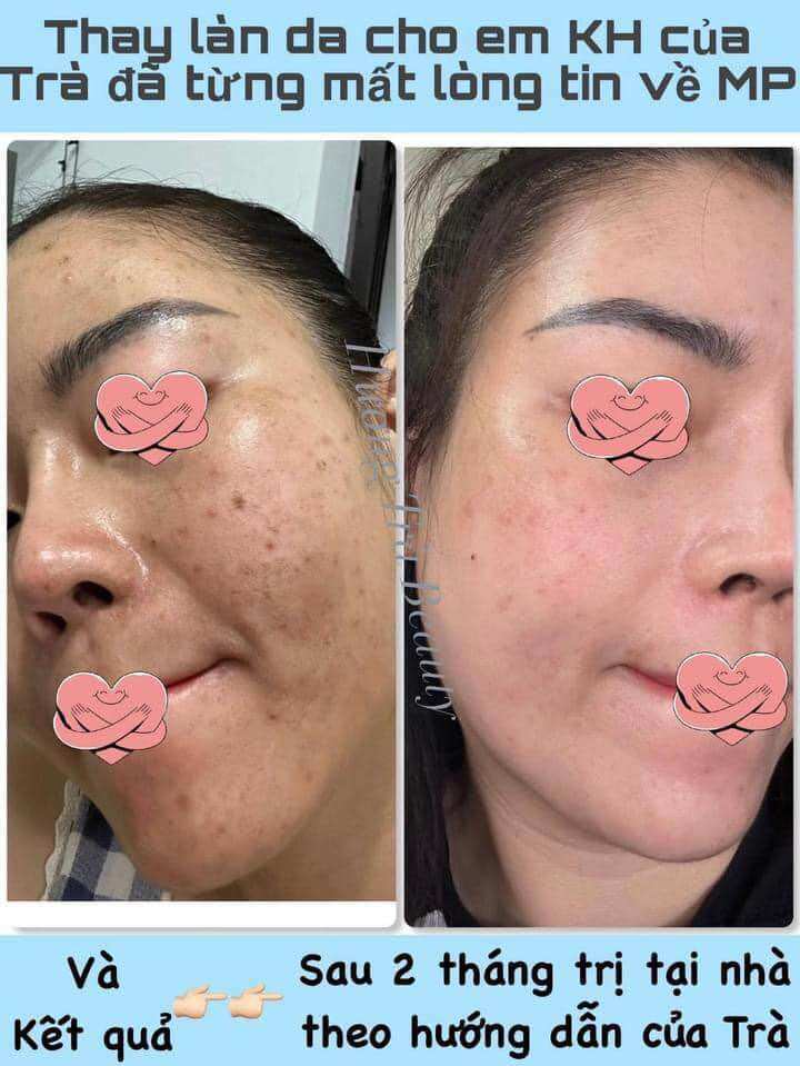[HCM] Gel rửa mặt thải độc Dermapeel