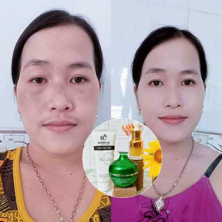 Kem chuyên nám huỳnh đỗ