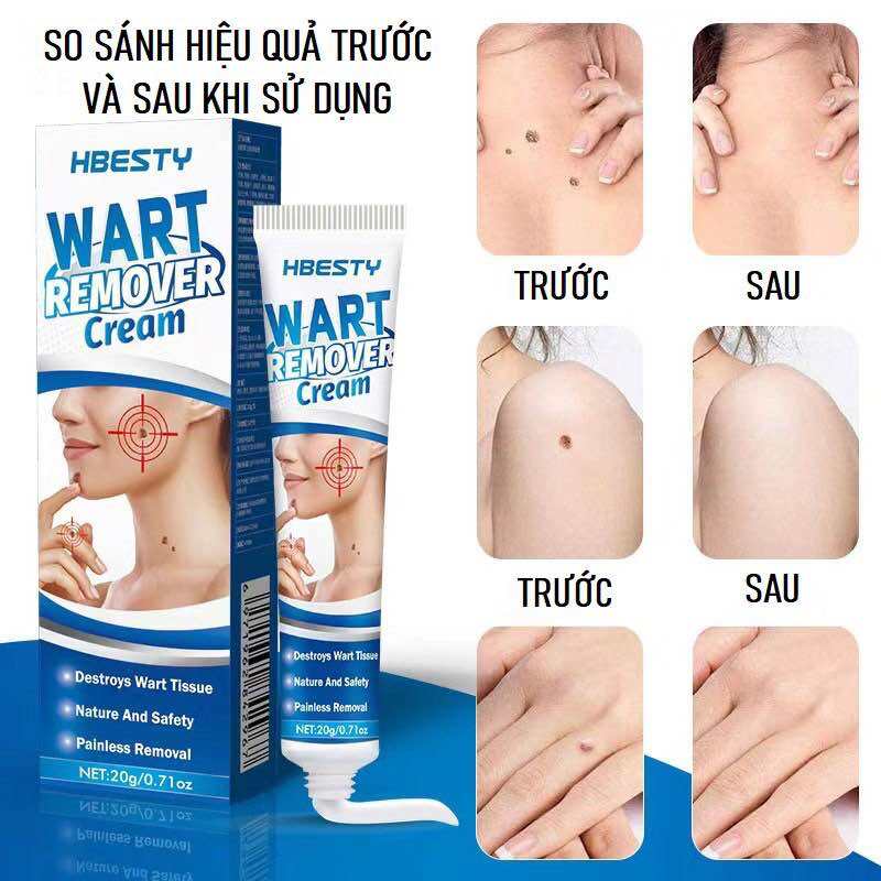 Kem Loại Bỏ Mụn HBESTY Wart Remover Cream Cam Kết Loại Bỏ Mụn Cóc Mụn Thịt Sẹo Lồi Gây Hại Cho Da