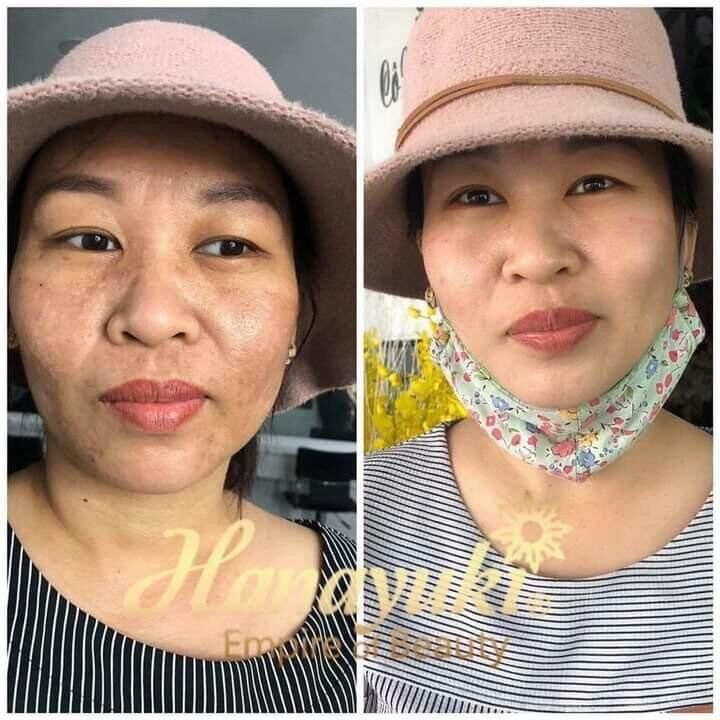 Serum Trị Nám Hanayuki - Hana Melasma