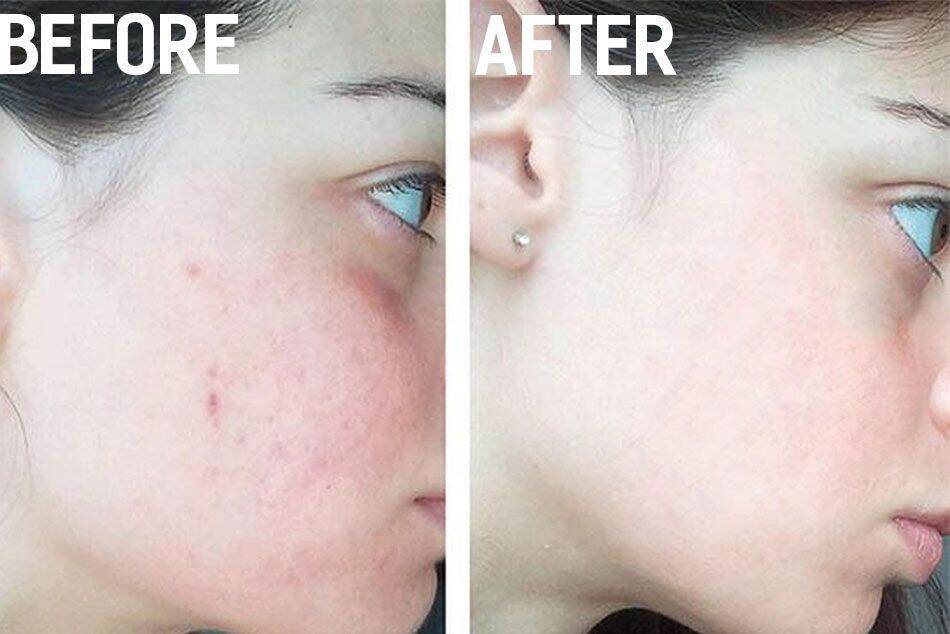 [CHÍNH HÃNG] Gel Giảm Mụn, Mờ Thâm Megaduo Túyp 15g