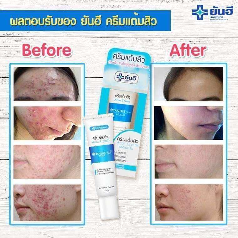 Kem thoa giảm mụn yanhee acne cream 10g thái lan