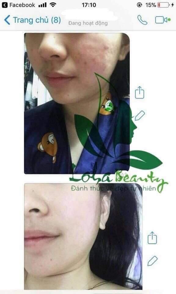 Tinh chất tái tạo loha 50ml (tặng tonner)