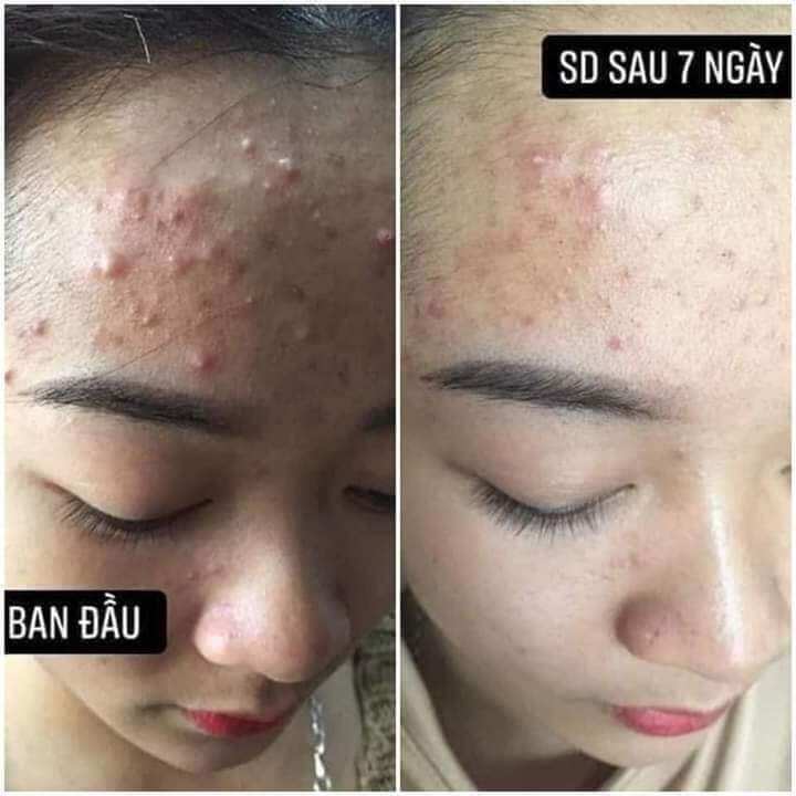 kem chuyên mụn huỳnh đỗ