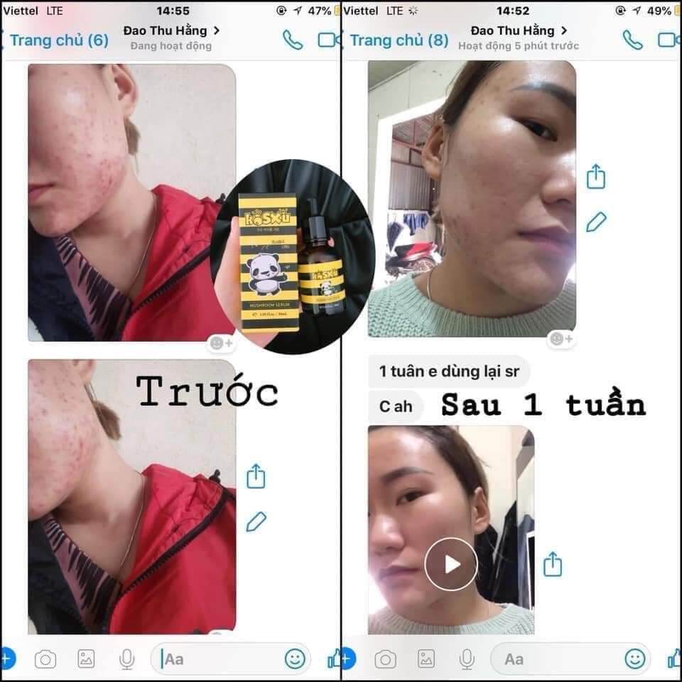Serum ong Kosxu căng bóng thánh mụn ẩn