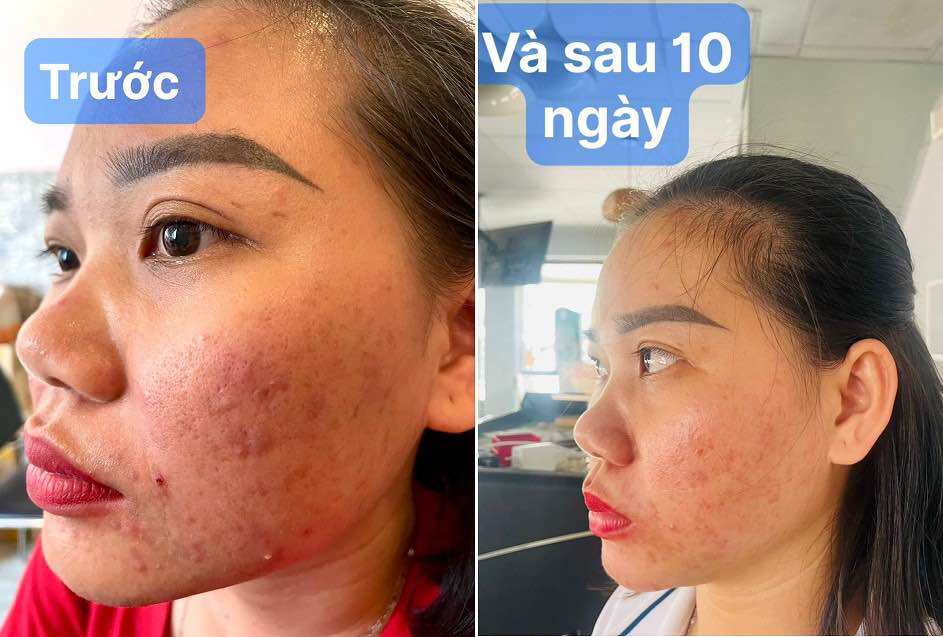 Kem mụn cao cấp E-ACNE (kem mụn organic)