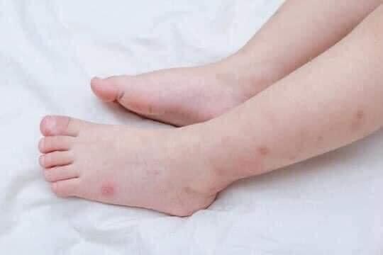 Kem bôi sẹo Scagel Kid Thái Lan