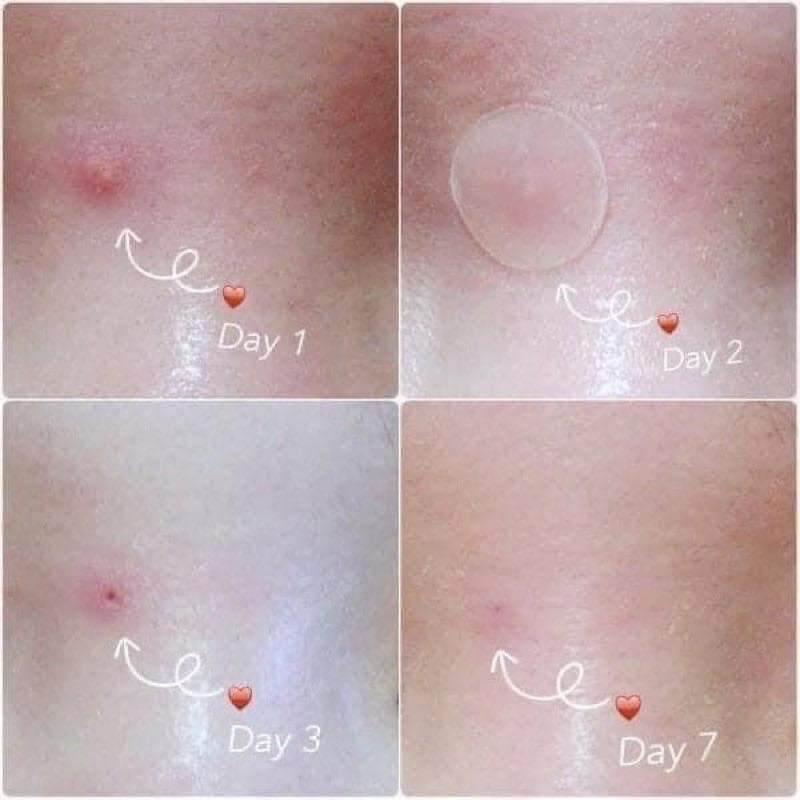 Miếng dán mụn Cosrx Acne Pimple Master Patch bịch 24 miếng (pack of 24pcs)