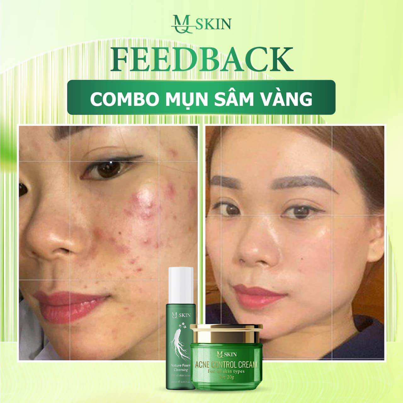 Cao Mụn Sâm Vàng (tặng kèm 3 nạ)