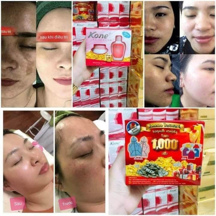 NÁM -TRẮNG DA KONE THÁI Mua Sét 3món tặng 1(1hộp kem, sữa rữa mặt,serum nám tặng 1 nạ)