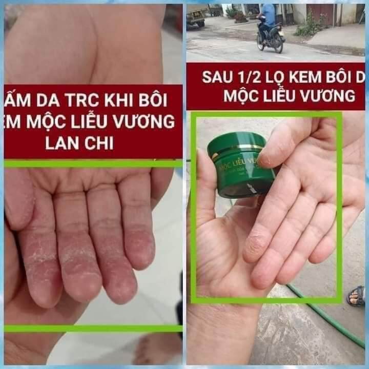 Kem Da Liễu Gia Truyền