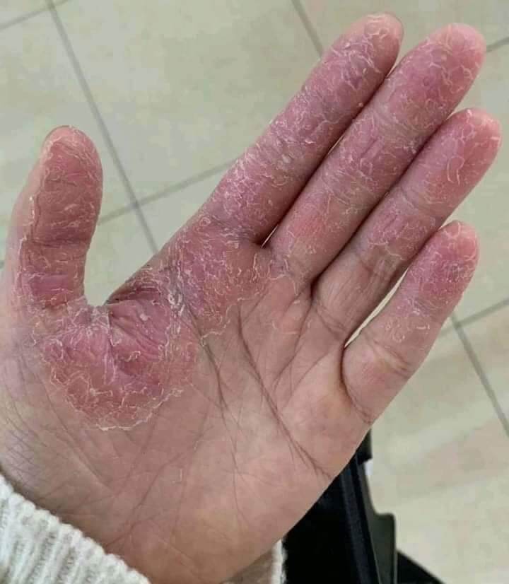 kem bôi da liễu , á sừng , nấm , ngứa nội địa trung chính hãng