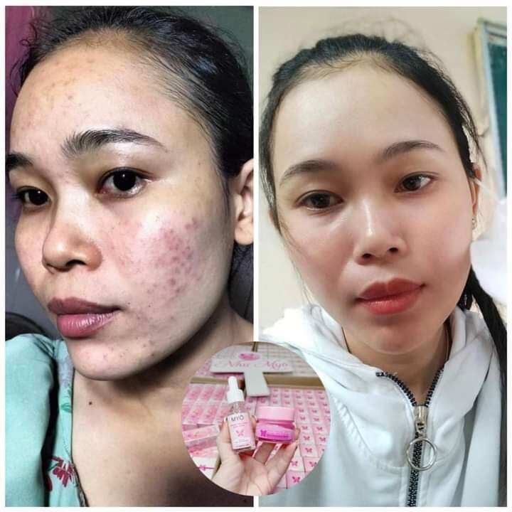 combo kem face + serum MYO 2 Tầng