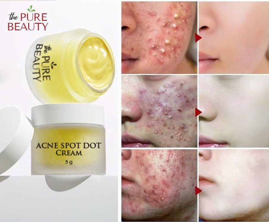 Kem chấm mụn viêm , mụn mủ, mụn bọc sưng ance spot dot cream