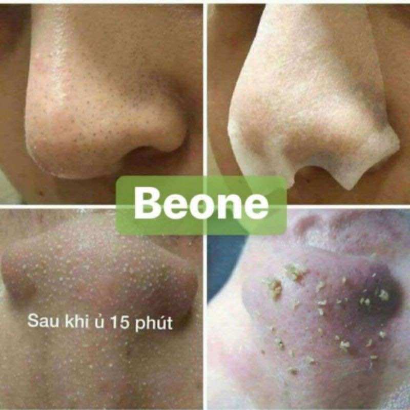 Ủ Mụn đầu đen, mụn cám Young Erc chai 30ml - SPA88