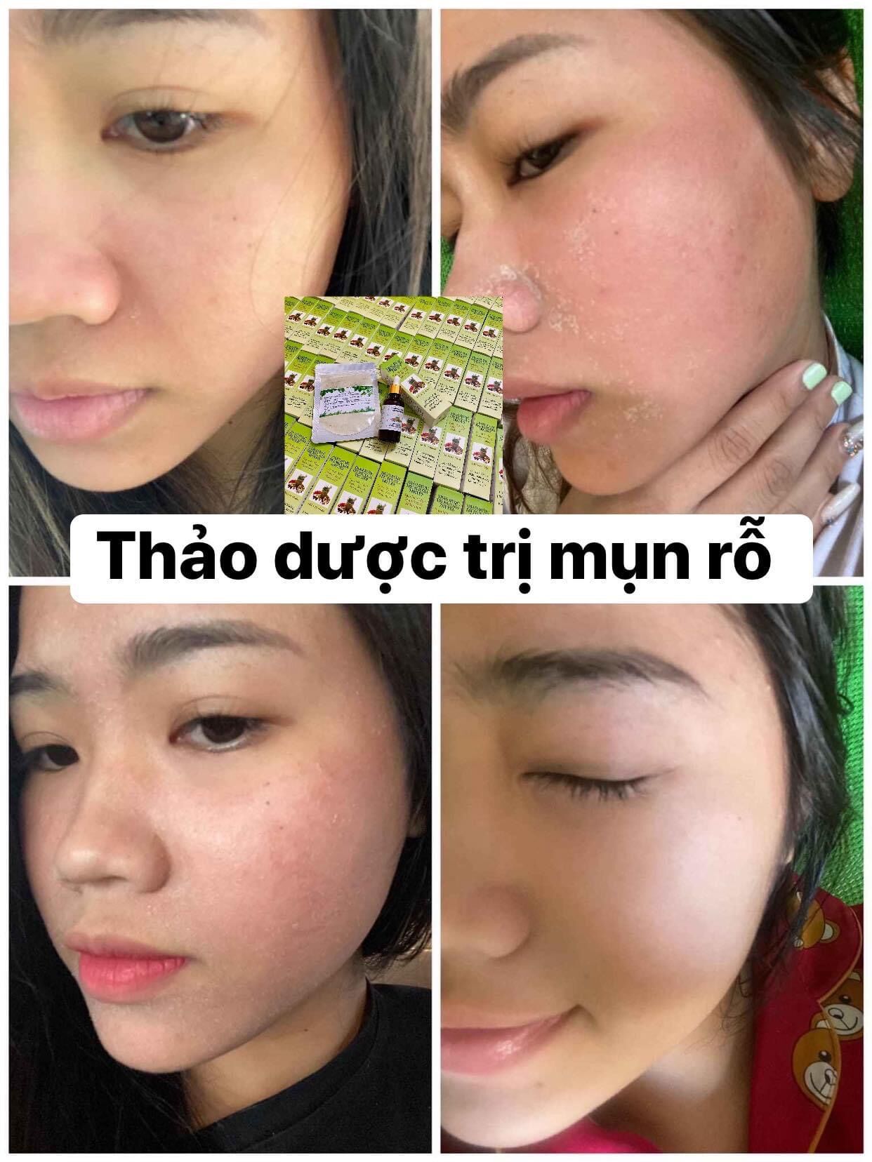 Compo Thảo Dược Sạch Mụn và Bột rửa mặt sạch dầu (50ml)