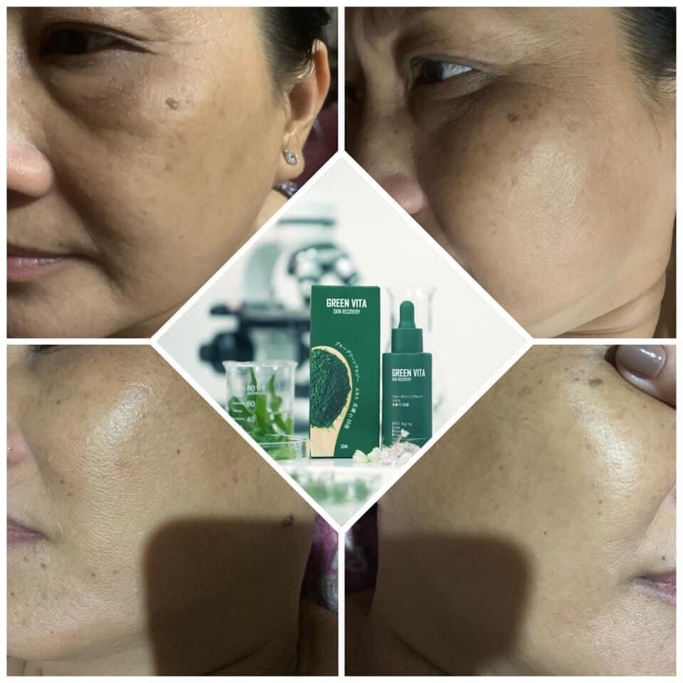 Combo Tái Sinh Da Green Vita (1 Serum và 1 Bột Rửa Mặt)