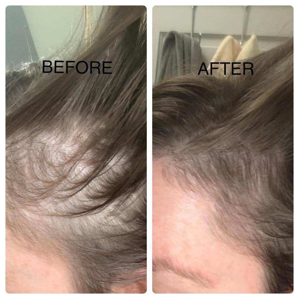 (Tặng Peo) 1 lọ Morr F5% Minoxidil hỗ trợ mọc tóc, giảm rụng tóc