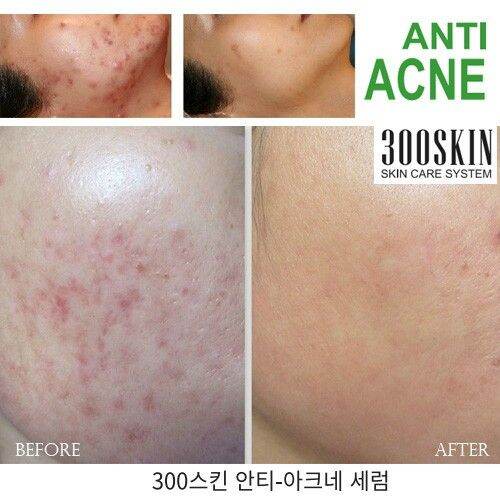 Serum mụn 300Skin