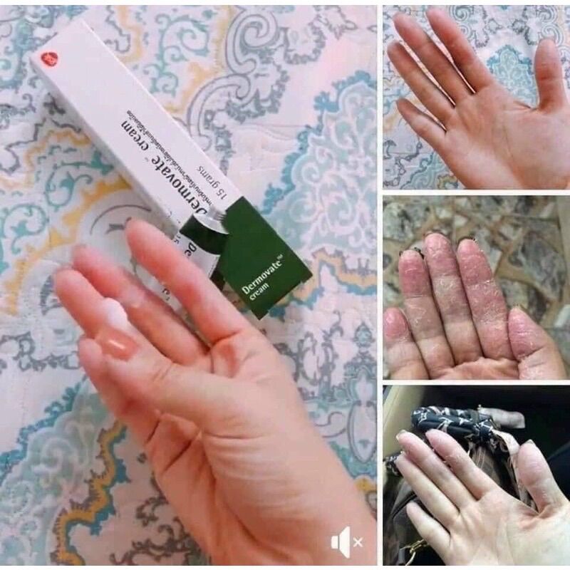 Kem Dẻmovate Giảm Khô Da Viêm Da Cream 15G Thái Lan Tuýp To Cam Kết Sản Phẩm Đúng Mô Tả Chất Lượng Đảm Bảo An Toàn Cho Người Sử Dụng