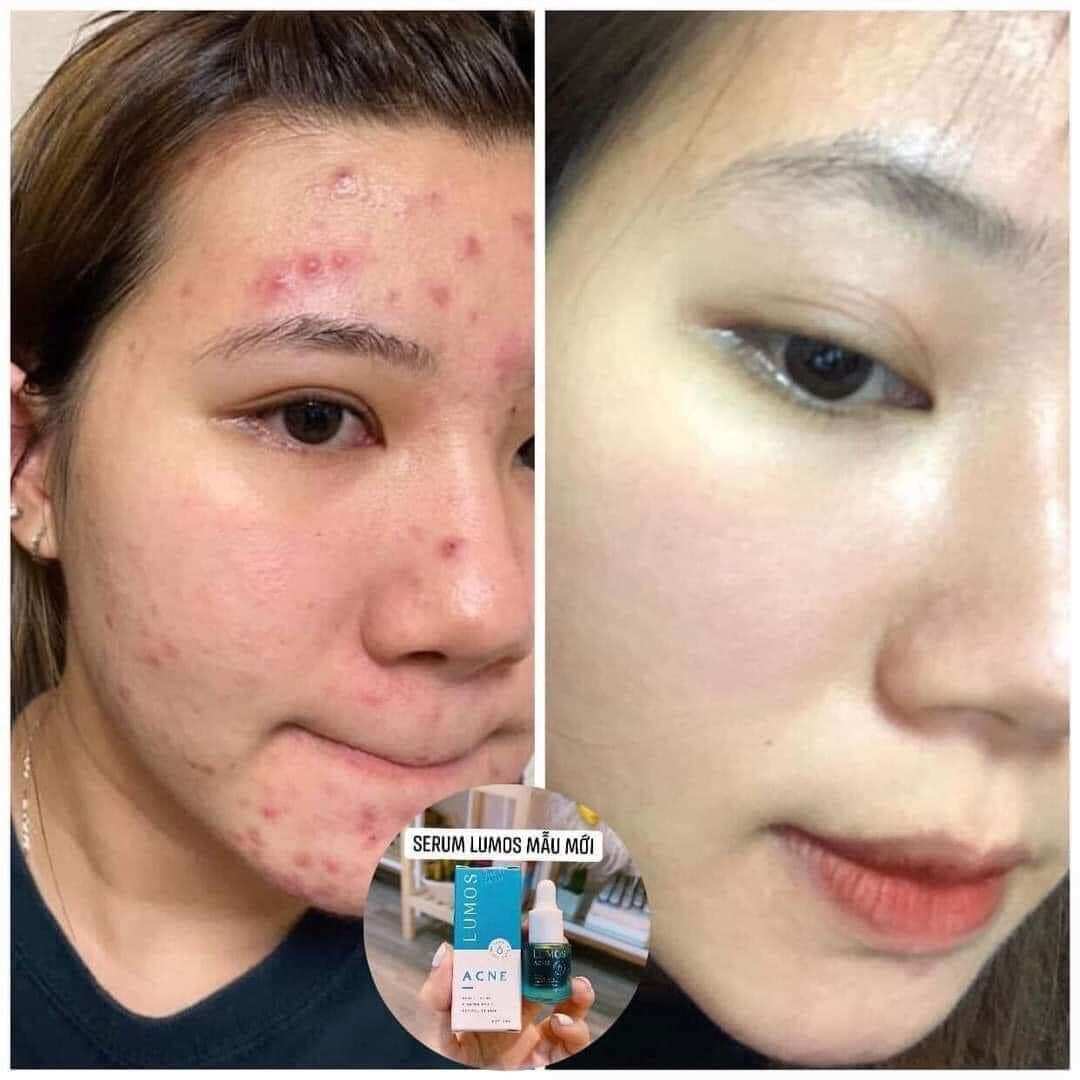 Serum mụn LUMOS ACNE 5ml chính hãng US