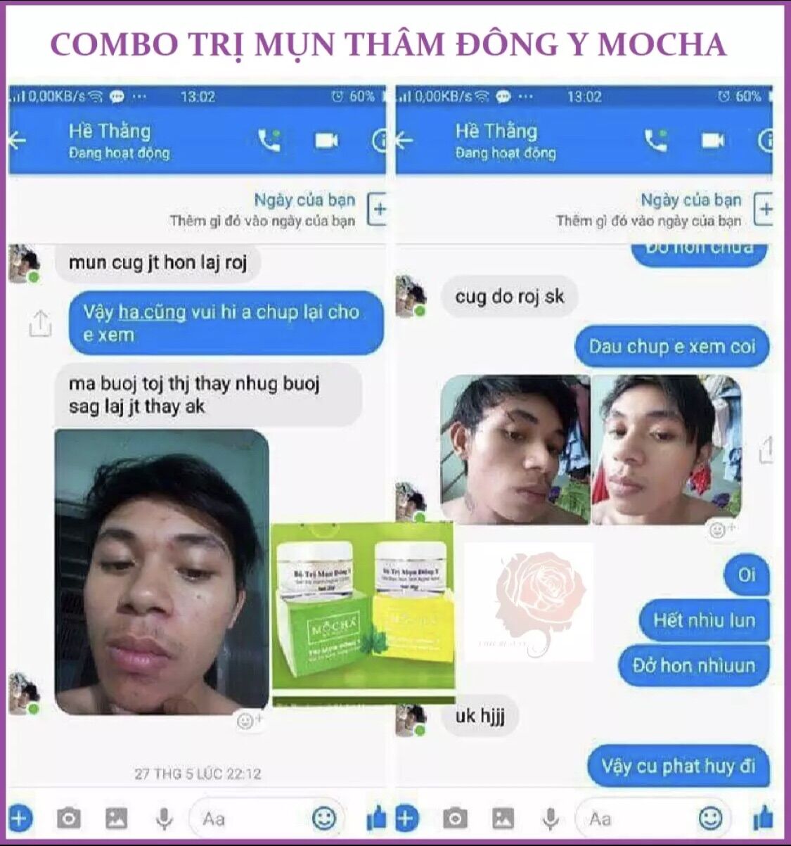 [CHÍNH HÃNG] BỘ MỤN THÂM MOCHA
