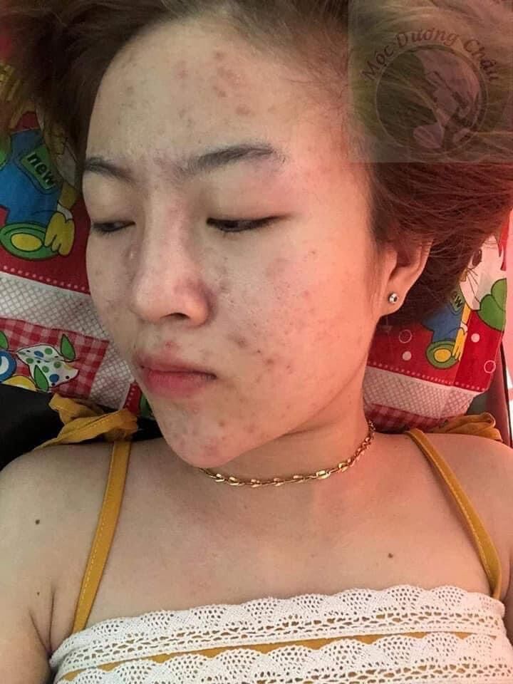 TÁI TẠO DA MỘC DƯƠNG CHÂU