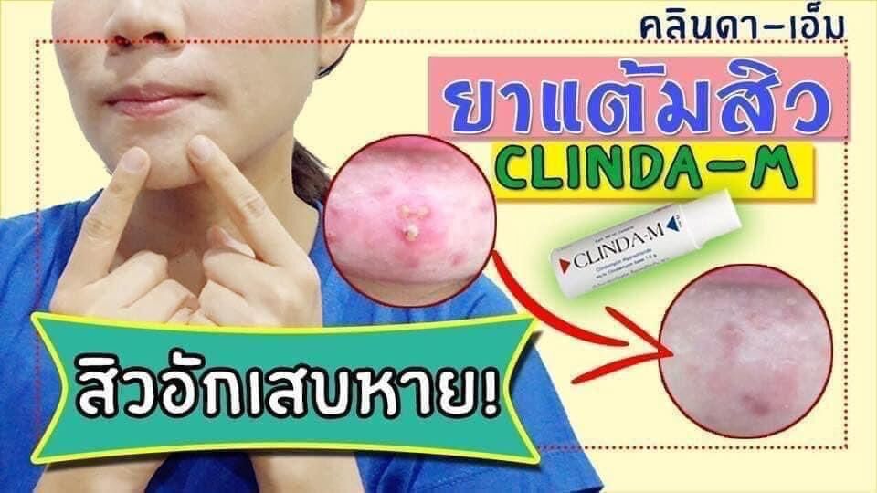 chấm mụn clinda 15ml thái lan