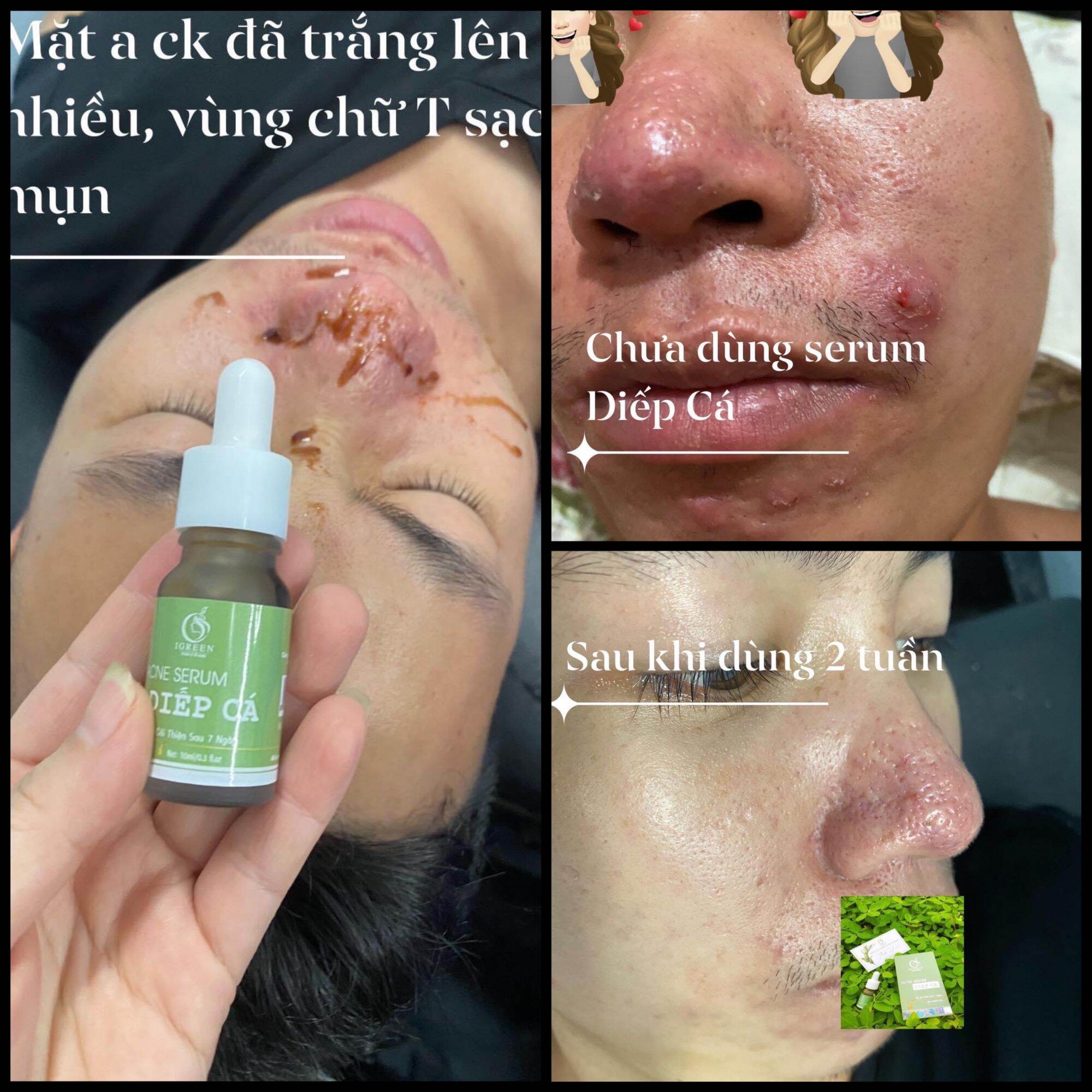 COMBO TOÀN DIỆN CHO DA HẾT MỤN, THÂM - COMBO DIẾP CÁ IGREEN